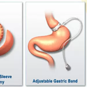Хирургическое лечение ожирения
